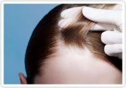 Terapia PRP capelli